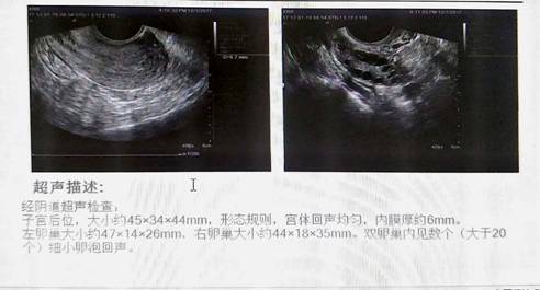 注释：双卵巢内见数个（大于20个）细小卵泡回声我们上述案例中的妹妹，